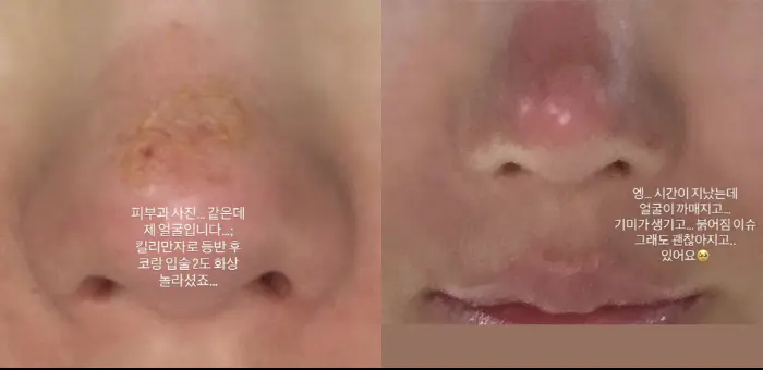 权恩妃展示吉乞力马扎罗山攀登后的皮肤损伤状态