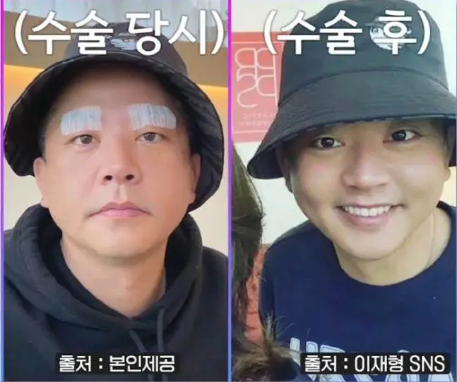 金俊浩分享因长期喜剧表演导致眼皮松弛并接受眼睑下垂矫正手术的前后对比