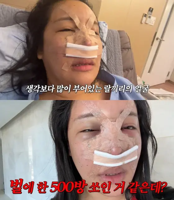 Ralral在YouTube视频中记录整容全过程,分享术后消肿心得